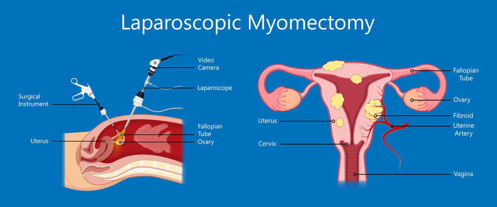 myomectomy-abanhospital