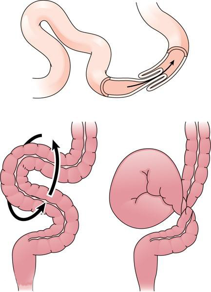 Ileus AbanHospital